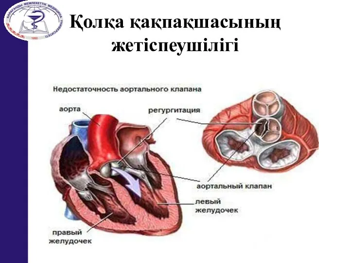 Қолқа қақпақшасының жетіспеушілігі