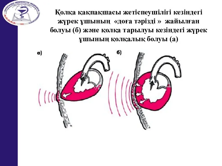 Қолқа қақпақшасы жетіспеушілігі кезіндегі жүрек ұшының «доға тәрізді » жайылған болуы