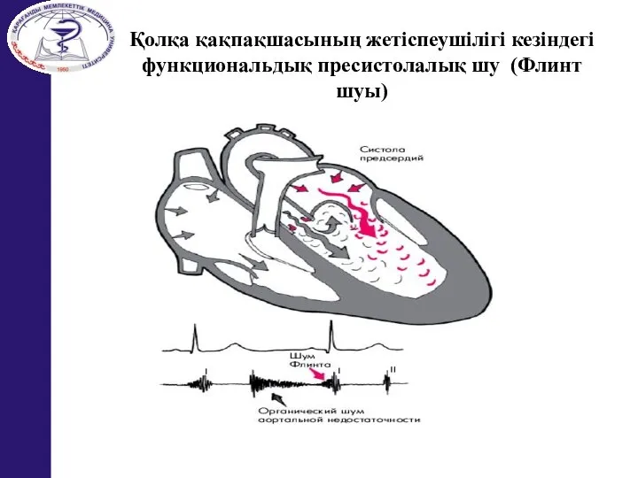 Қолқа қақпақшасының жетіспеушілігі кезіндегі функциональдық пресистолалық шу (Флинт шуы)