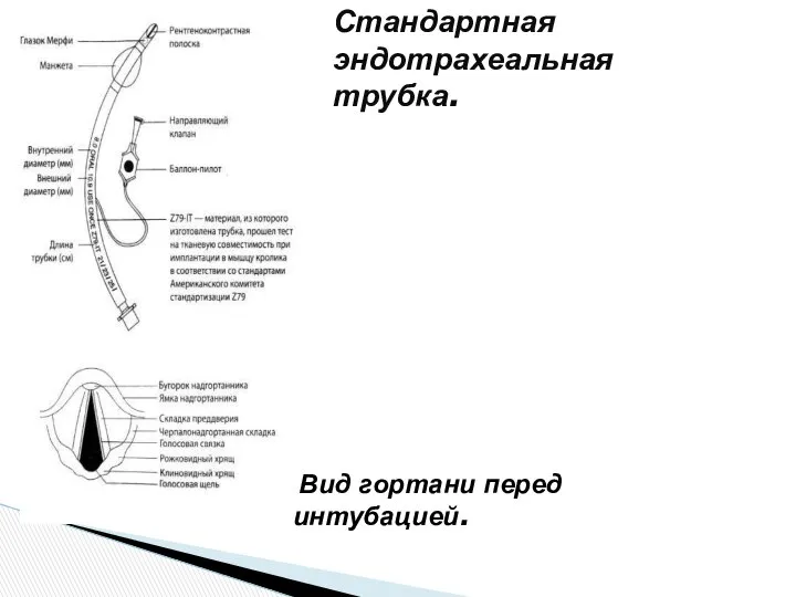 Стандартная эндотрахеальная трубка. Вид гортани перед интубацией.