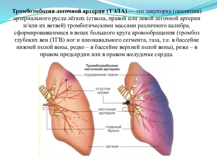 Тромбоэмболия легочной артерии (ТЭЛА) — это закупорка (окклюзия) артериального русла лёгких