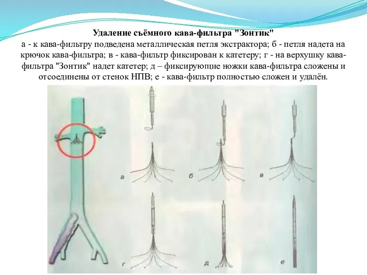 Удаление съёмного кава-фильтра "Зонтик" а - к кава-фильтру подведена металлическая петля