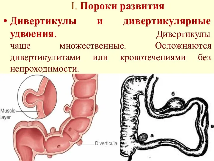 I. Пороки развития Дивертикулы и дивертикулярные удвоения. Дивертикулы чаще множественные. Осложняются дивертикулитами или кровотечениями без непроходимости.