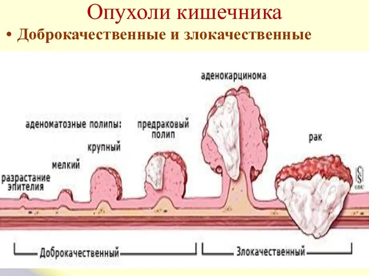 Опухоли кишечника Доброкачественные и злокачественные