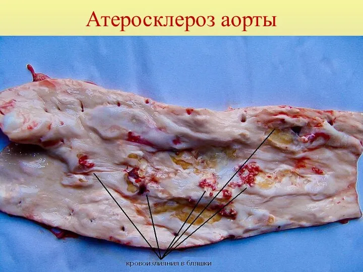 Атеросклероз аорты