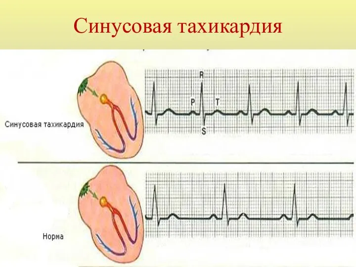 Синусовая тахикардия