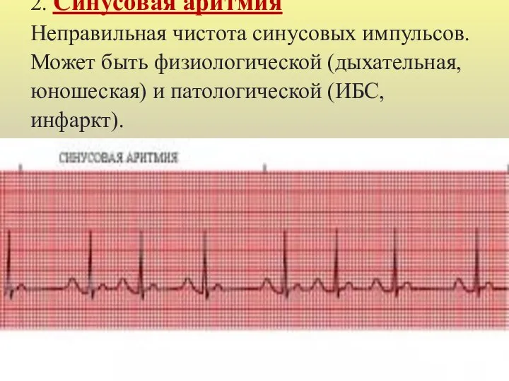 2. Синусовая аритмия Неправильная чистота синусовых импульсов. Может быть физиологической (дыхательная, юношеская) и патологической (ИБС, инфаркт).