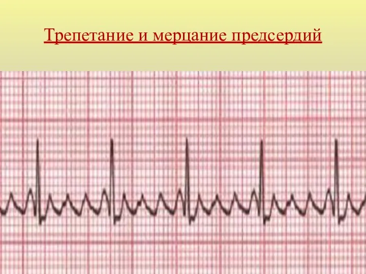 Трепетание и мерцание предсердий