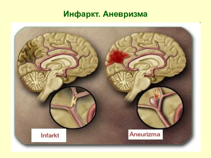 Инфаркт. Аневризма