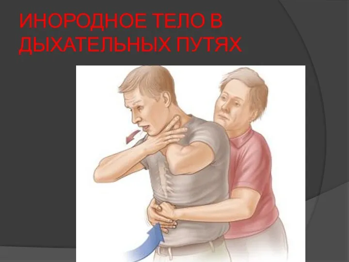 ИНОРОДНОЕ ТЕЛО В ДЫХАТЕЛЬНЫХ ПУТЯХ