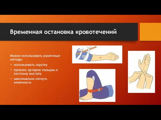 Временная остановка кровотечений Можно использовать различные методы: использовать скрутку прижать артерию