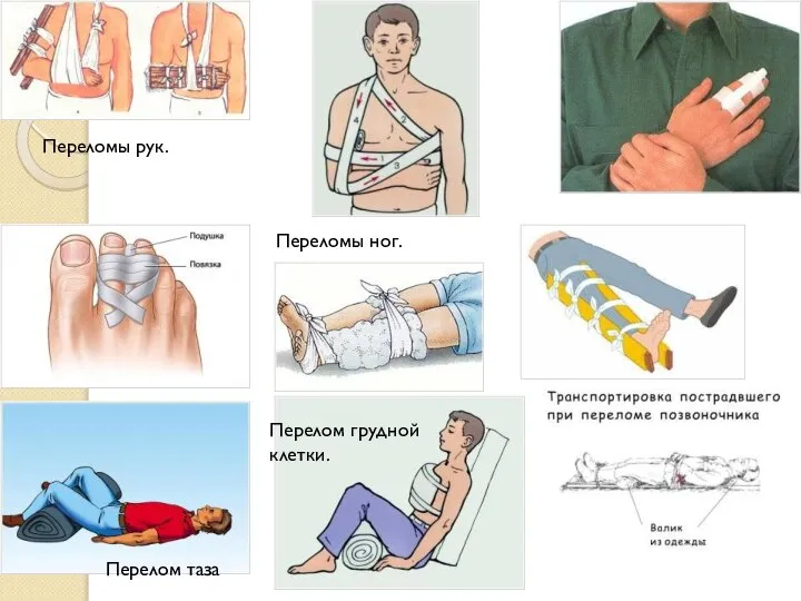 Переломы рук. Переломы ног. Перелом таза Перелом грудной клетки.