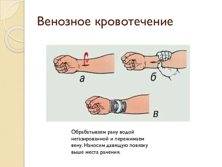 Венозное кровотечение Обрабатываем рану водой негазированной и пережимаем вену. Наносим давящую повязку выше места ранения.