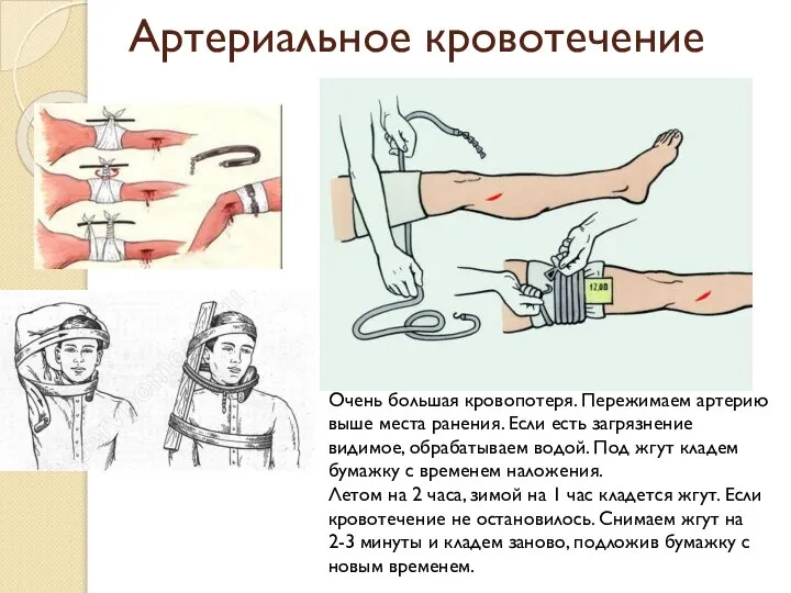 Артериальное кровотечение Очень большая кровопотеря. Пережимаем артерию выше места ранения. Если