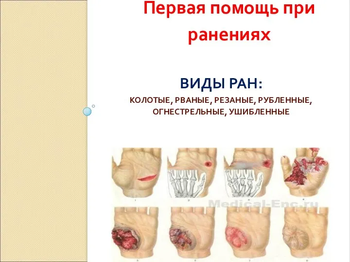 ВИДЫ РАН: КОЛОТЫЕ, РВАНЫЕ, РЕЗАНЫЕ, РУБЛЕННЫЕ, ОГНЕСТРЕЛЬНЫЕ, УШИБЛЕННЫЕ Первая помощь при ранениях