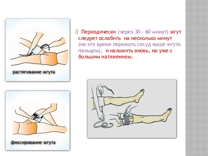 Периодически (через 30 - 60 минут) жгут следует ослабить на несколько