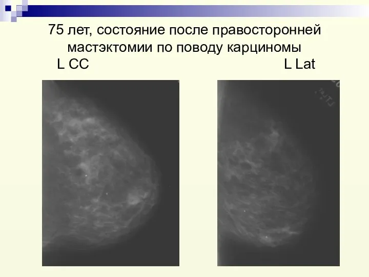 75 лет, состояние после правосторонней мастэктомии по поводу карциномы L СС L Lat