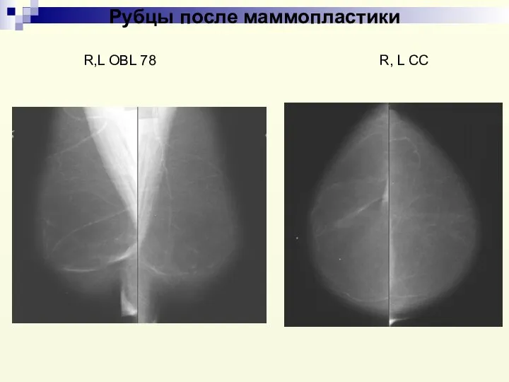 Рубцы после маммопластики R,L OBL 78 R, L CC