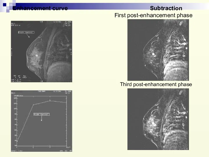Enhancement curve Subtraction First post-enhancement phase Third post-enhancement phase