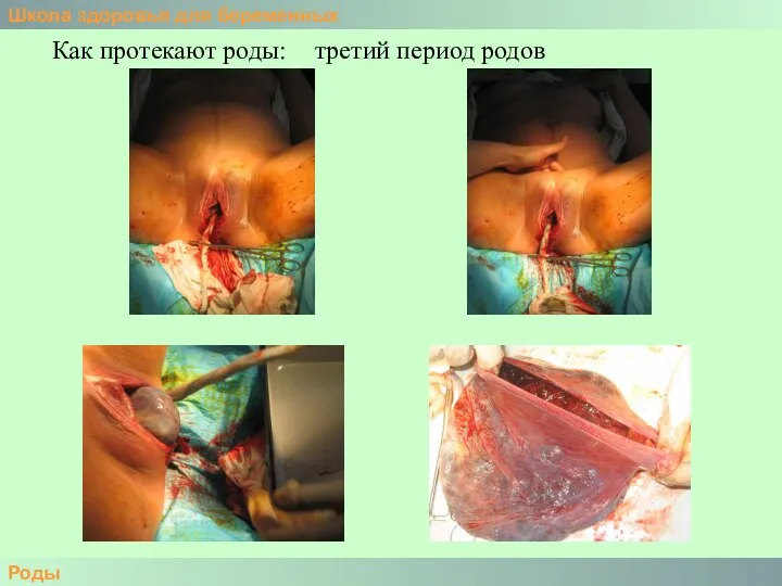 Школа здоровья для беременных Роды Как протекают роды: третий период родов