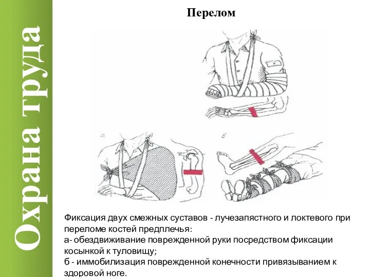 Охрана труда Перелом Фиксация двух смежных суставов - лучезапястного и локтевого