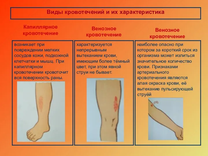 Капиллярное кровотечение Венозное кровотечение Венозное кровотечение