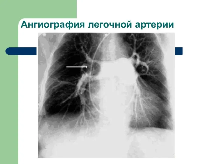 Ангиография легочной артерии