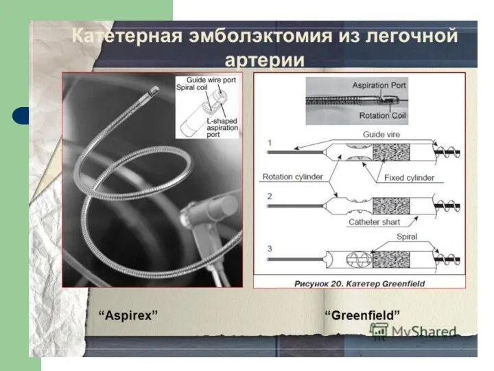 Катетерная тромбэкстракция/фрагментация проксимального тромба легочной артерии