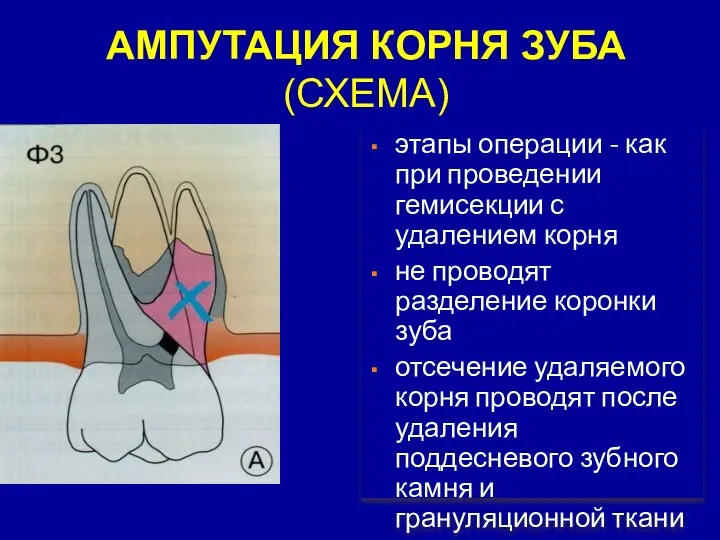 АМПУТАЦИЯ КОРНЯ ЗУБА (СХЕМА) этапы операции - как при проведении гемисекции