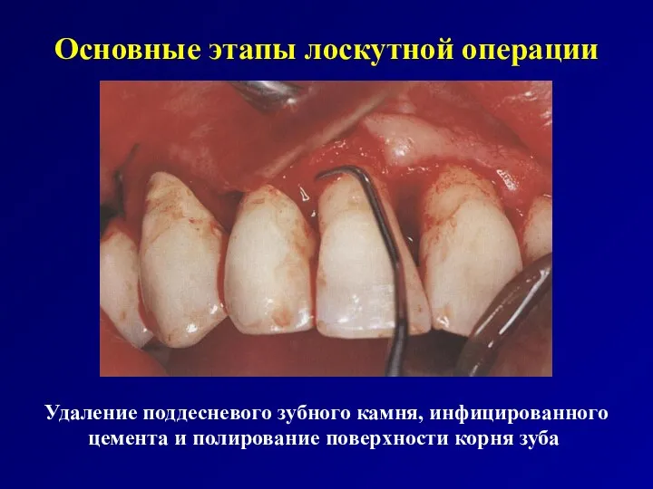 Основные этапы лоскутной операции Удаление поддесневого зубного камня, инфицированного цемента и полирование поверхности корня зуба