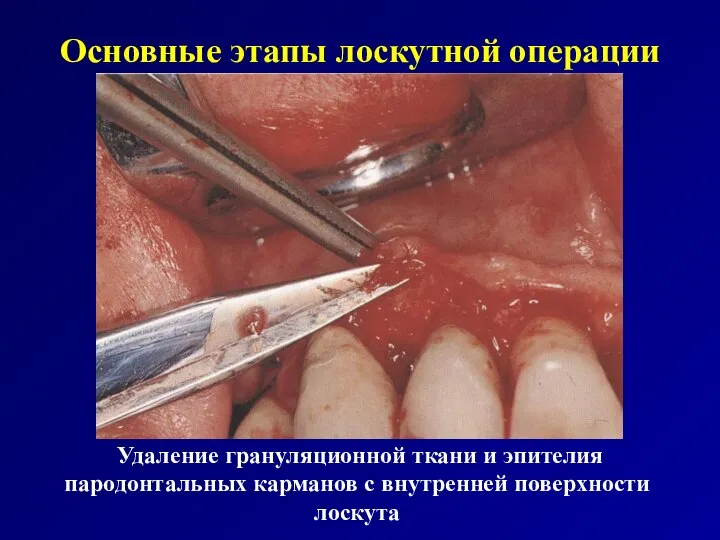 Основные этапы лоскутной операции Удаление грануляционной ткани и эпителия пародонтальных карманов с внутренней поверхности лоскута