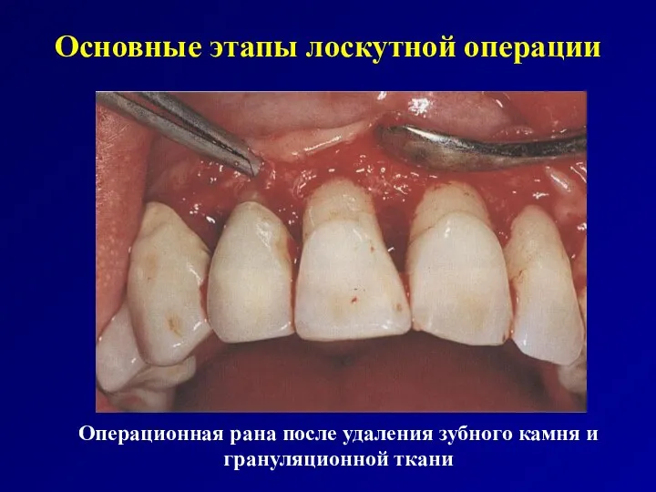 Основные этапы лоскутной операции Операционная рана после удаления зубного камня и грануляционной ткани
