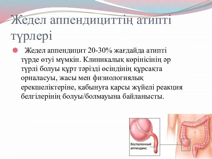 Жедел аппендициттің атипті түрлері Жедел аппендицит 20-30% жағдайда атипті түрде өтуі