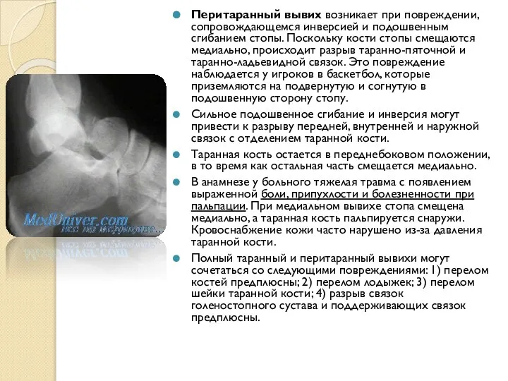 Перитаранный вывих возникает при повреждении, сопровождающемся инверсией и подошвенным сгибанием стопы.