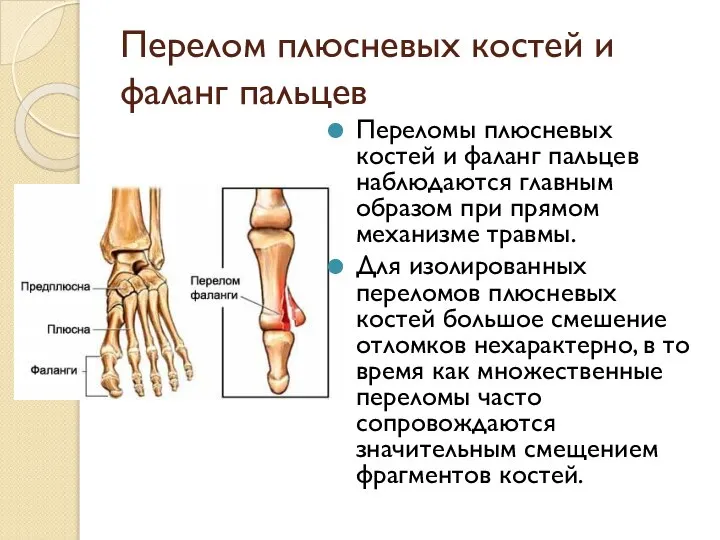 Перелом плюсневых костей и фаланг пальцев Переломы плюсневых костей и фаланг