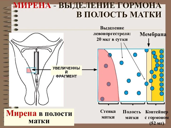 МИРЕНА - ВЫДЕЛЕНИЕ ГОРМОНА В ПОЛОСТЬ МАТКИ УВЕЛИЧЕННЫЙ ФРАГМЕНТ Мирена в