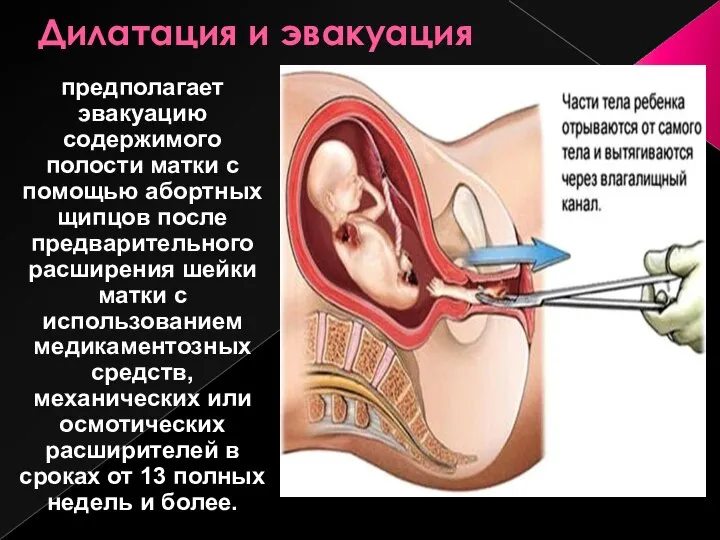 Дилатация и эвакуация предполагает эвакуацию содержимого полости матки с помощью абортных