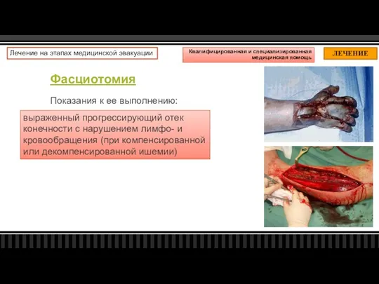 Фасциотомия Показания к ее выполнению: ЛЕЧЕНИЕ Лечение на этапах медицинской эвакуации