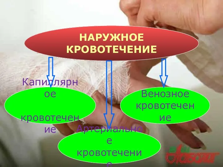 Венозное кровотечение НАРУЖНОЕ КРОВОТЕЧЕНИЕ Капиллярное кровотечение Артериальное кровотечение