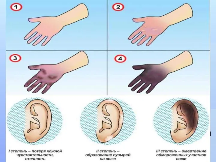 3 степень - происходит омертвление всех слоев кожи, пузыри наполнены темной
