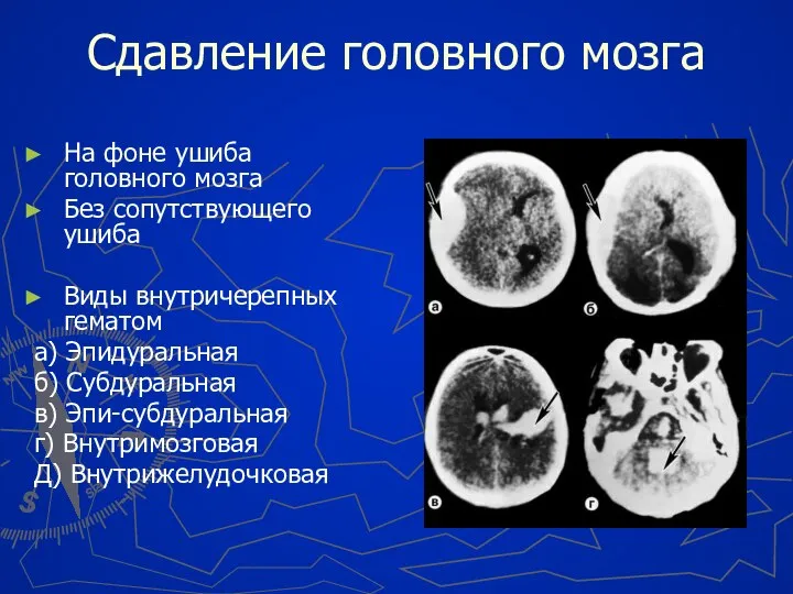 Сдавление головного мозга На фоне ушиба головного мозга Без сопутствующего ушиба