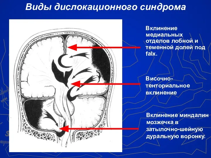 Вклинение медиальных отделов лобной и теменной долей под falx. Вклинение миндалин