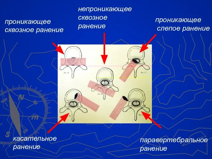 проникающее слепое ранение проникающее сквозное ранение касательное ранение непроникающее сквозное ранение паравертебральное ранение