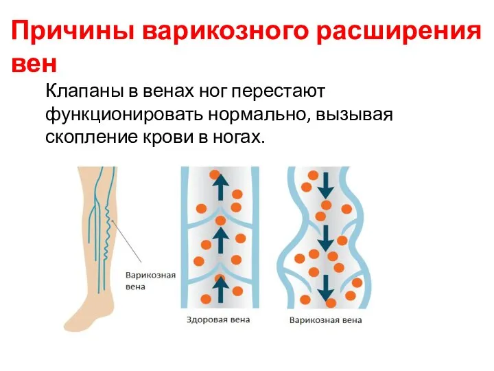Причины варикозного расширения вен Клапаны в венах ног перестают функционировать нормально, вызывая скопление крови в ногах.