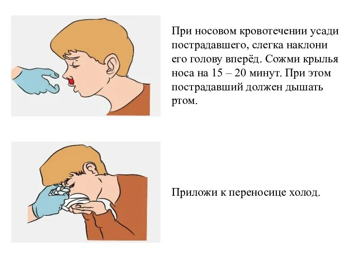 При носовом кровотечении усади пострадавшего, слегка наклони его голову вперёд. Сожми