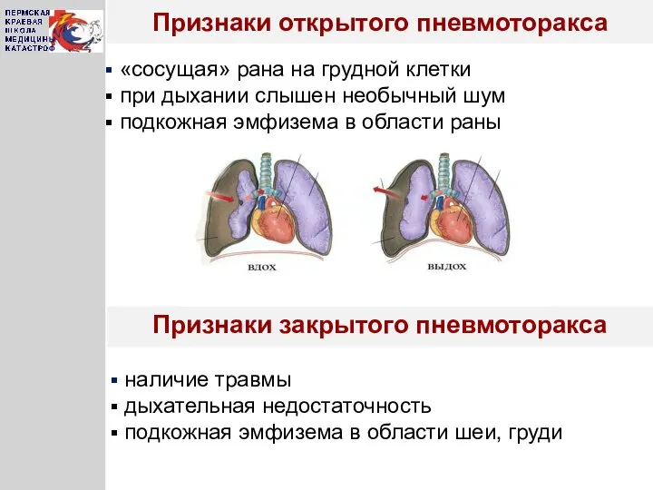 Признаки открытого пневмоторакса Признаки закрытого пневмоторакса «сосущая» рана на грудной клетки