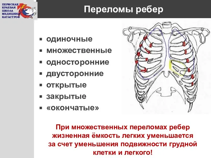 Переломы ребер одиночные множественные односторонние двусторонние открытые закрытые «окончатые» При множественных