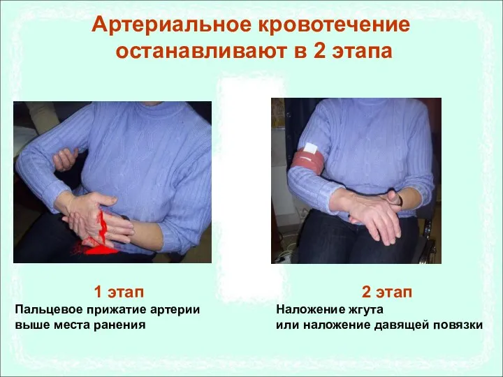 Артериальное кровотечение останавливают в 2 этапа 1 этап Пальцевое прижатие артерии