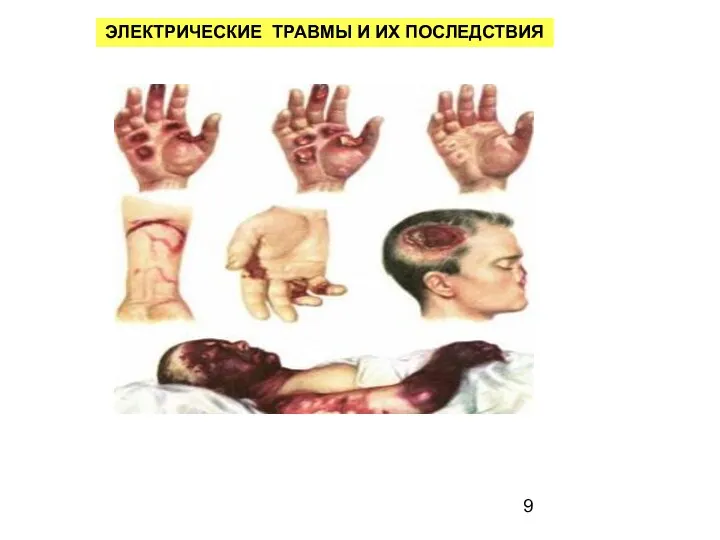 ЭЛЕКТРИЧЕСКИЕ ТРАВМЫ И ИХ ПОСЛЕДСТВИЯ