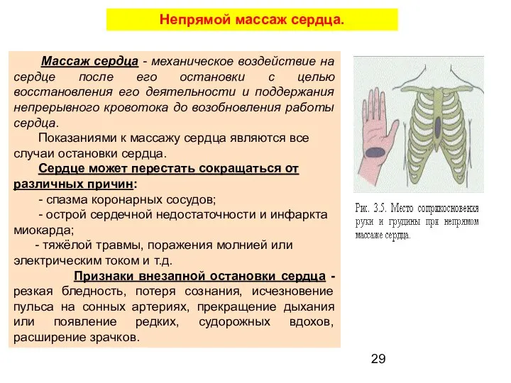 Непрямой массаж сердца. Массаж сердца - механическое воздействие на сердце после